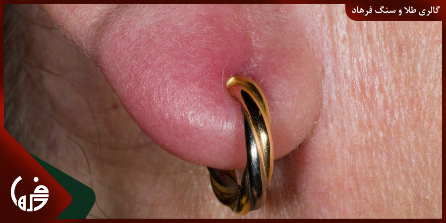 حساسیت به گوشواره طلا